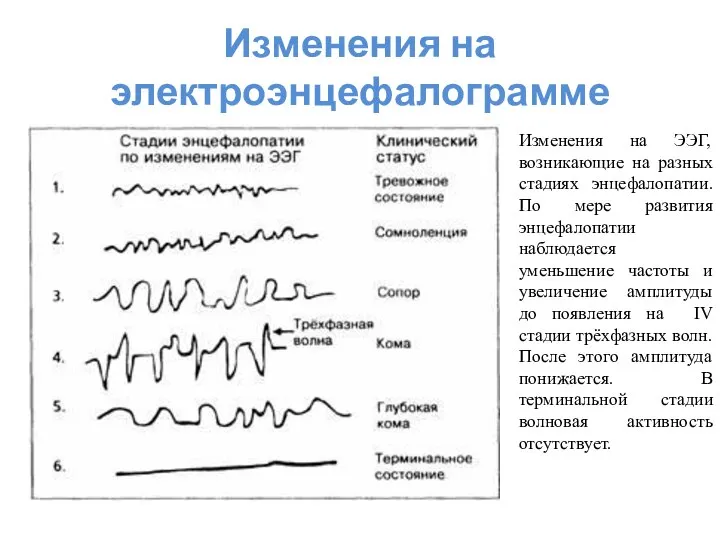 Изменения на электроэнцефалограмме Изменения на ЭЭГ, возникающие на разных стадиях энцефалопатии.