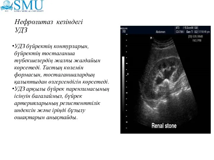Нефролитаз кезіндегі УДЗ УДЗ бүйректің контурларын, бүйректің тостағанша түбекшелердің жалпы жағдайын