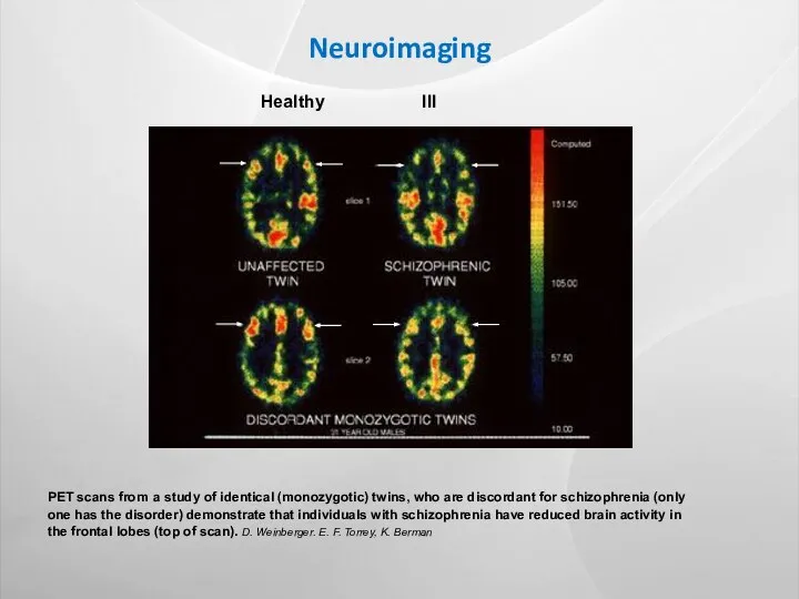 Neuroimaging PET scans from a study of identical (monozygotic) twins, who