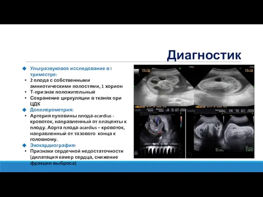 Диагностика Ультразвуковое исследование в I триместре: 2 плода с собственными амниотическими