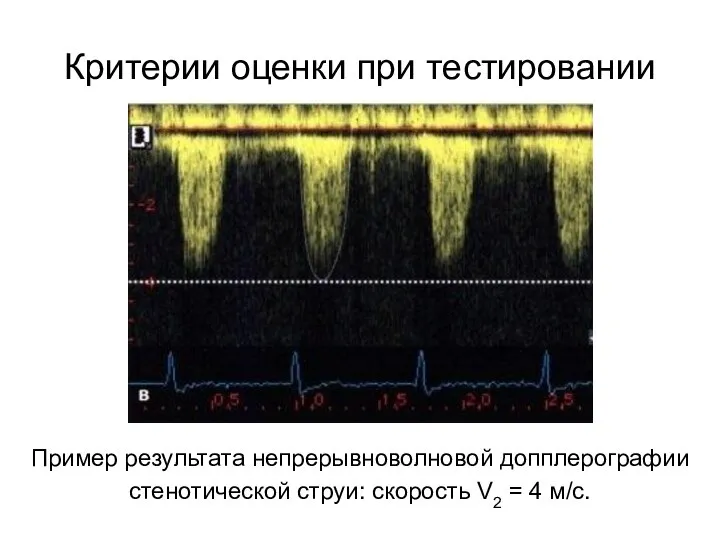 Критерии оценки при тестировании Пример результата непрерывноволновой допплерографии стенотической струи: скорость V2 = 4 м/с.