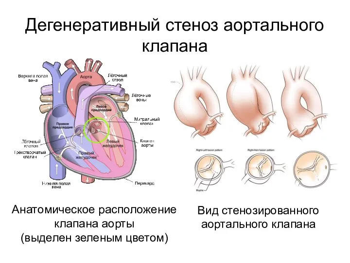 Дегенеративный стеноз аортального клапана Вид стенозированного аортального клапана Анатомическое расположение клапана аорты (выделен зеленым цветом)