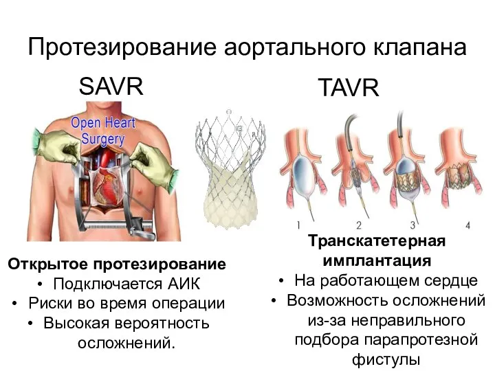 Протезирование аортального клапана Открытое протезирование Подключается АИК Риски во время операции