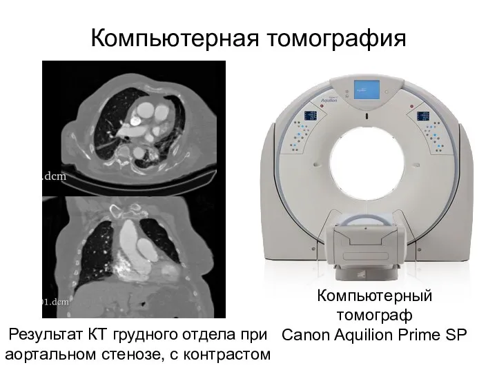 Компьютерная томография Результат КТ грудного отдела при аортальном стенозе, с контрастом