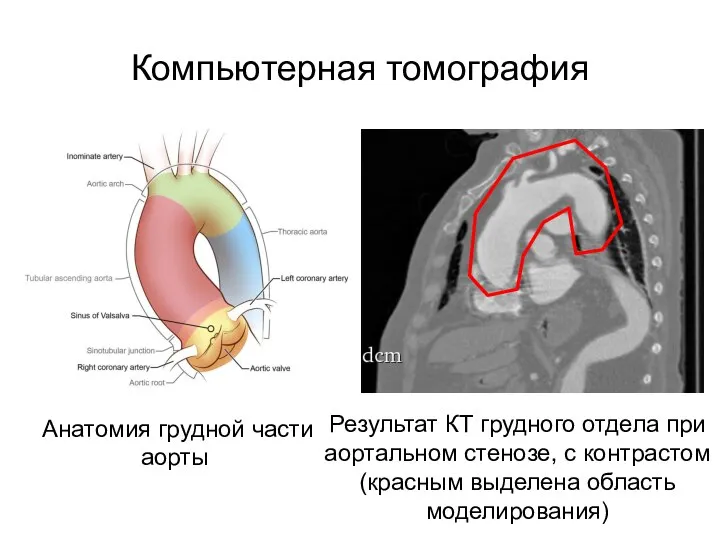 Результат КТ грудного отдела при аортальном стенозе, с контрастом (красным выделена