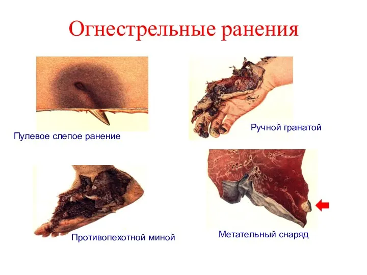 Огнестрельные ранения Пулевое слепое ранение Противопехотной миной Ручной гранатой Метательный снаряд