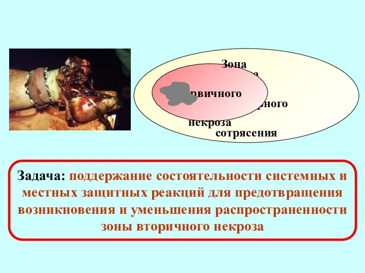 Зона молекулярного сотрясения Зона первичного некроза Задача: поддержание состоятельности системных и