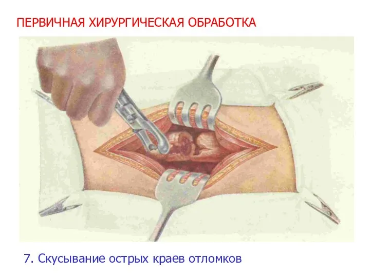 ПЕРВИЧНАЯ ХИРУРГИЧЕСКАЯ ОБРАБОТКА 7. Скусывание острых краев отломков