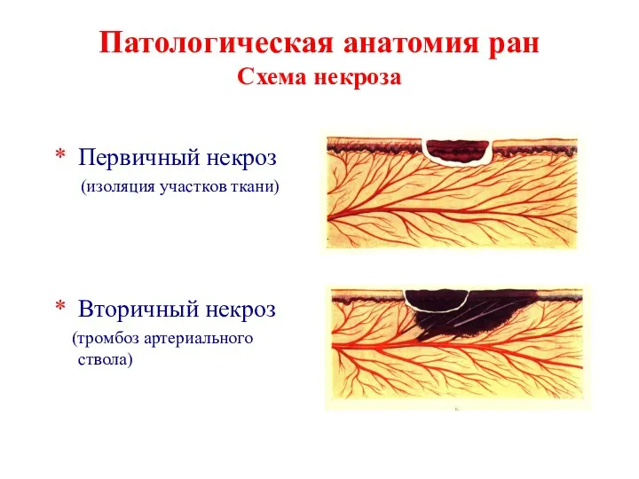 Патологическая анатомия ран Схема некроза Первичный некроз (изоляция участков ткани) Вторичный некроз (тромбоз артериального ствола)