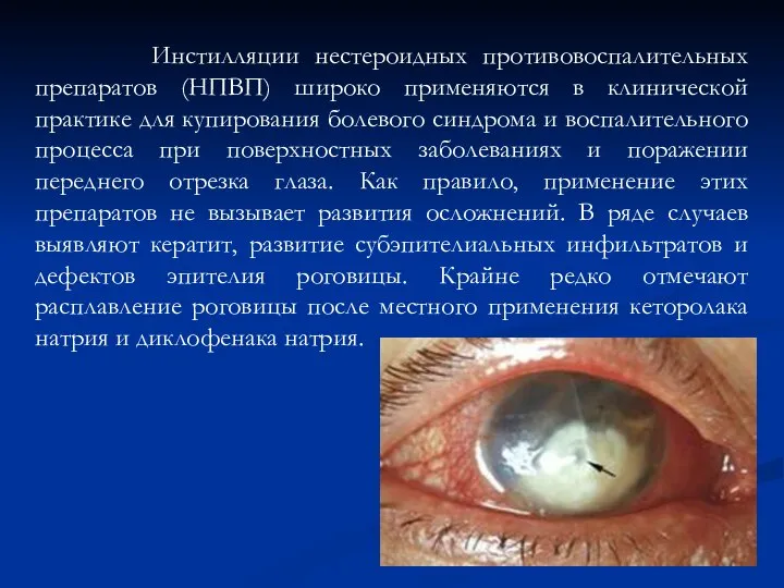 Инстилляции нестероидных противовоспалительных препаратов (НПВП) широко применяются в клинической практике для