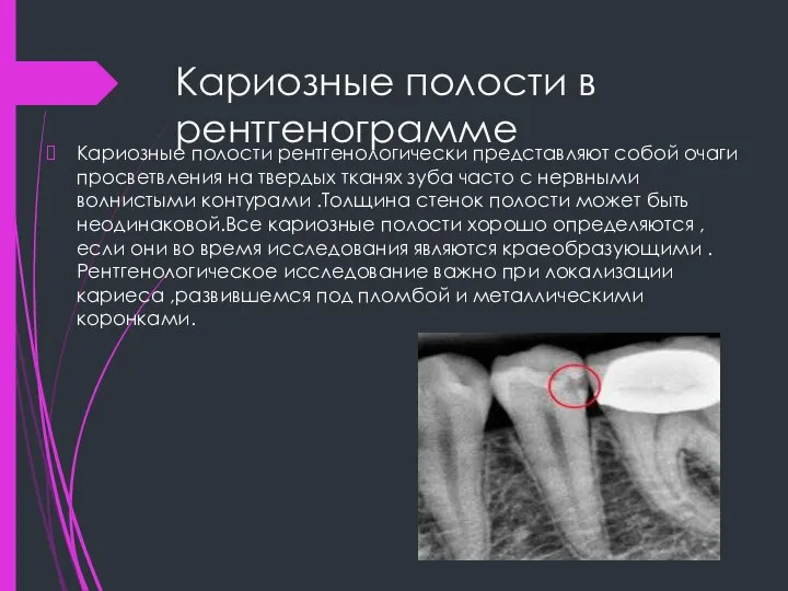 Кариозные полости в рентгенограмме Кариозные полости рентгенологически представляют собой очаги просветвления