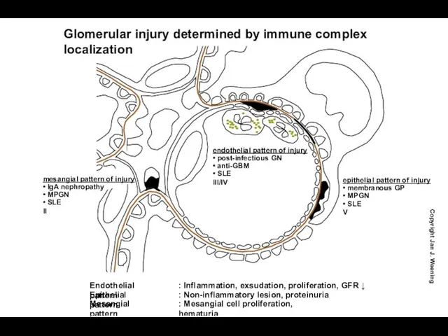Endothelial pattern : Inflammation, exsudation, proliferation, GFR ↓ Epithelial pattern :