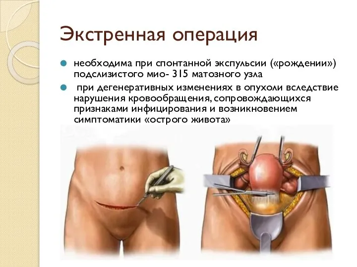 Экстренная операция необходима при спонтанной экспульсии («рождении») подслизистого мио- 315 матозного