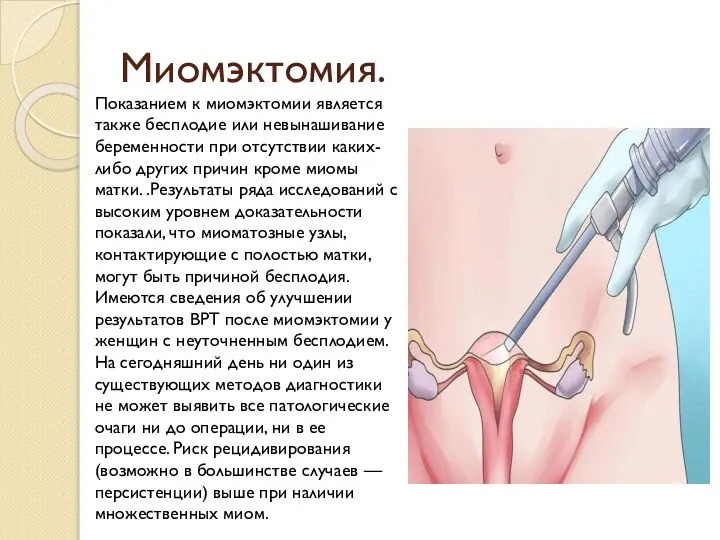 Миомэктомия. Показанием к миомэктомии является также бесплодие или невынашивание беременности при