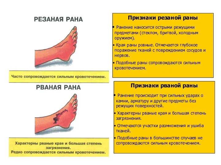 . Признаки резаной раны Ранение наносится острыми режущими предметами (стеклом, бритвой,