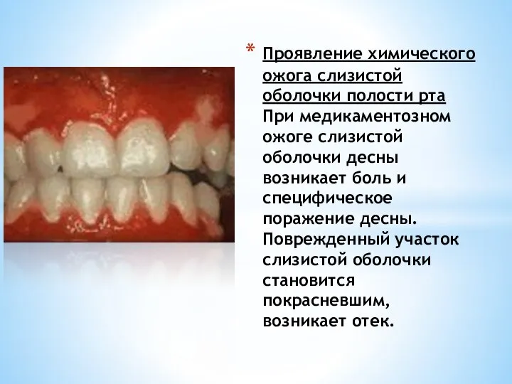 Проявление химического ожога слизистой оболочки полости рта При медикаментозном ожоге слизистой