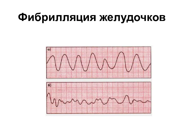 Фибрилляция желудочков