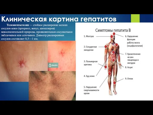 Клиническая картина гепатитов Телеангиэктазия — стойкое расширение мелких сосудов кожи (артериол,