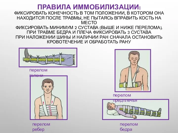 ПРАВИЛА ИММОБИЛИЗАЦИИ: ФИКСИРОВАТЬ КОНЕЧНОСТЬ В ТОМ ПОЛОЖЕНИИ, В КОТОРОМ ОНА НАХОДИТСЯ