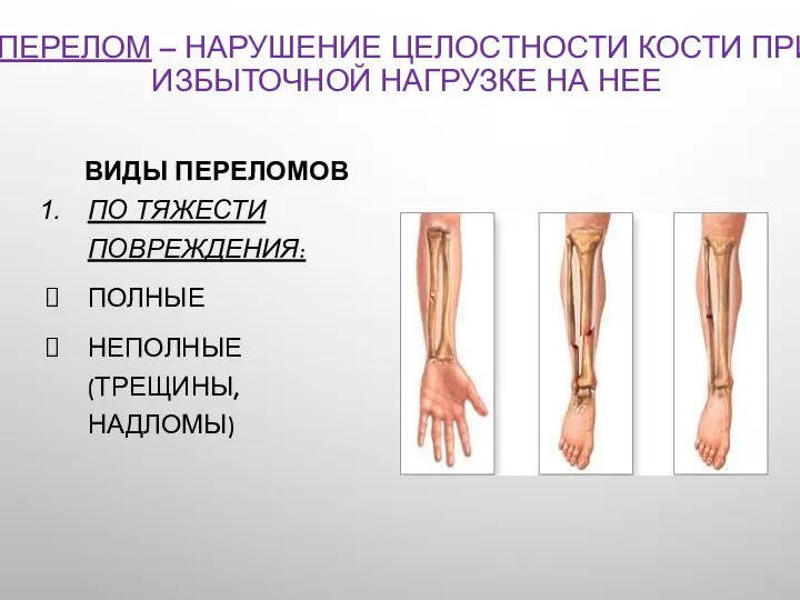 ПЕРЕЛОМ – НАРУШЕНИЕ ЦЕЛОСТНОСТИ КОСТИ ПРИ ИЗБЫТОЧНОЙ НАГРУЗКЕ НА НЕЕ ВИДЫ