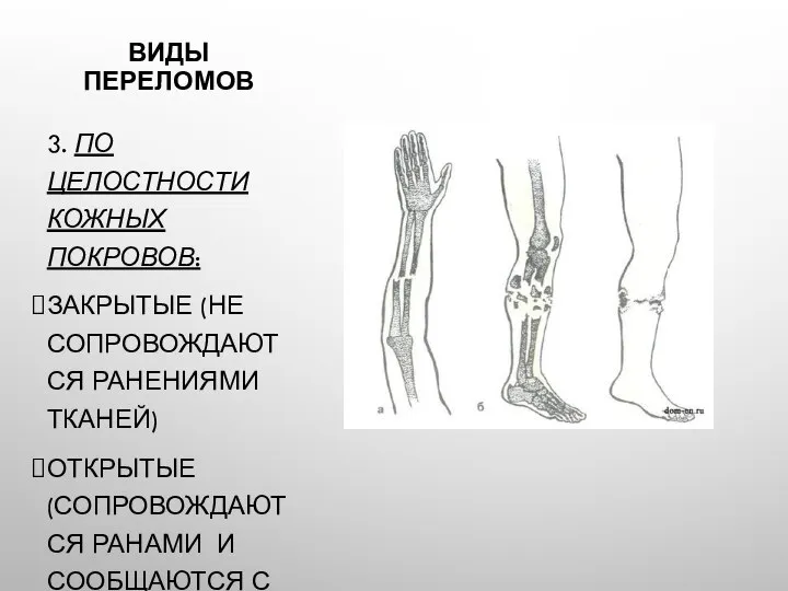 ВИДЫ ПЕРЕЛОМОВ 3. ПО ЦЕЛОСТНОСТИ КОЖНЫХ ПОКРОВОВ: ЗАКРЫТЫЕ (НЕ СОПРОВОЖДАЮТСЯ РАНЕНИЯМИ