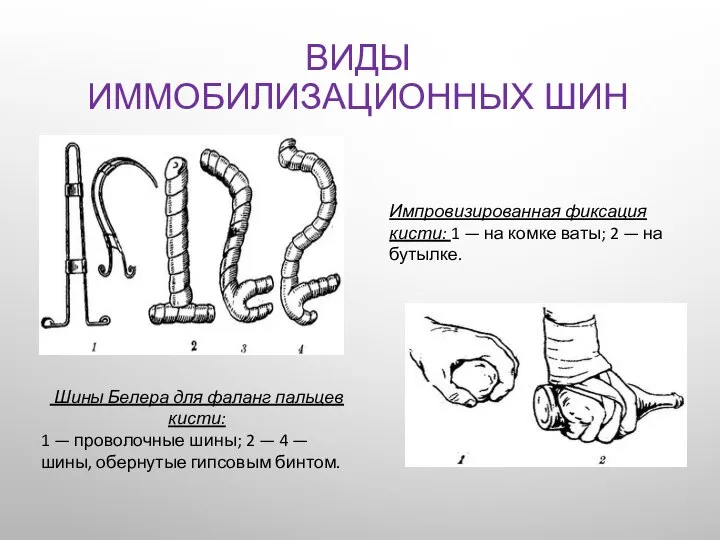 ВИДЫ ИММОБИЛИЗАЦИОННЫХ ШИН Шины Белера для фаланг пальцев кисти: 1 —