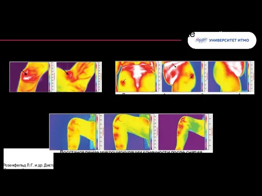 Колонтитул Применение термографии в диагностике в травматологии и ортопедии * Розенфельд