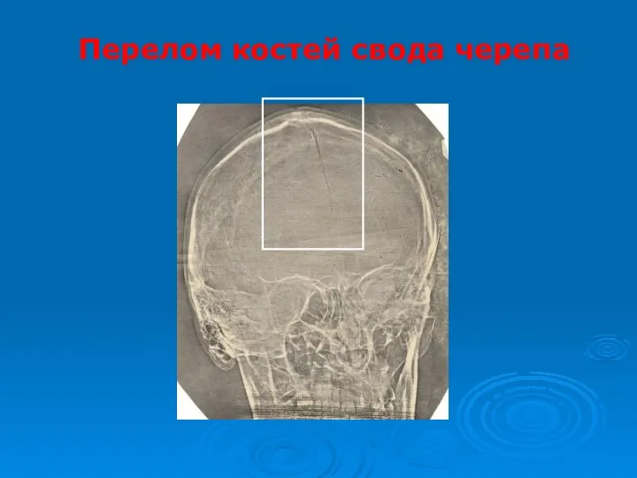 Перелом костей свода черепа