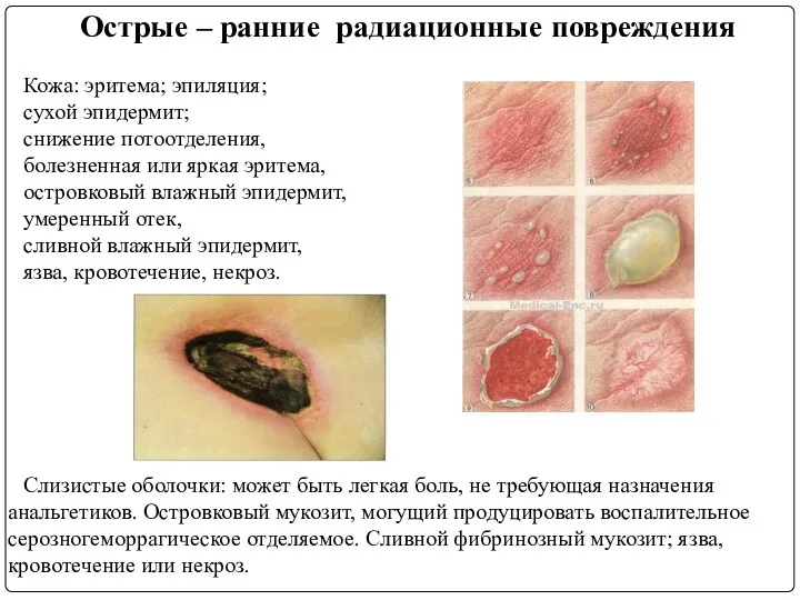 Острые – ранние радиационные повреждения Кожа: эритема; эпиляция; сухой эпидермит; снижение