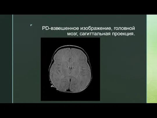 PD-взвешенное изображение, головной мозг, сагиттальная проекция.