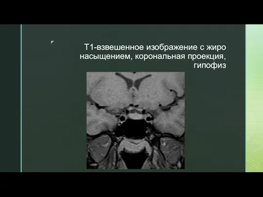 T1-взвешенное изображение с жиро насыщением, корональная проекция, гипофиз