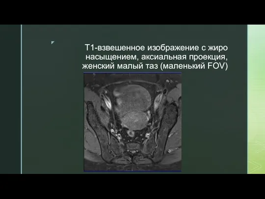 T1-взвешенное изображение с жиро насыщением, аксиальная проекция, женский малый таз (маленький FOV)