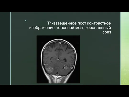 T1-взвешенное пост контрастное изображение, головной мозг, корональный срез