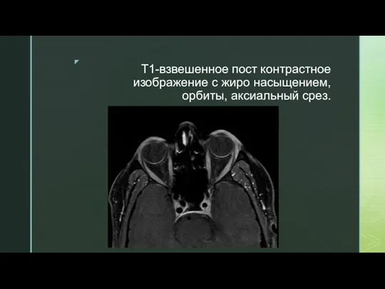 T1-взвешенное пост контрастное изображение с жиро насыщением, орбиты, аксиальный срез.