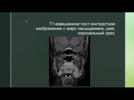 T1-взвешенное пост контрастное изображение с жиро насыщением, шея, корональный срез.