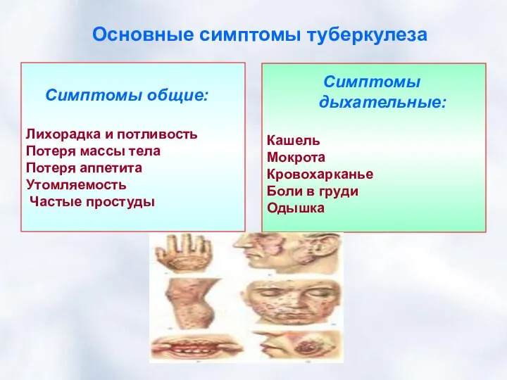 Основные симптомы туберкулеза Симптомы общие: Лихорадка и потливость Потеря массы тела