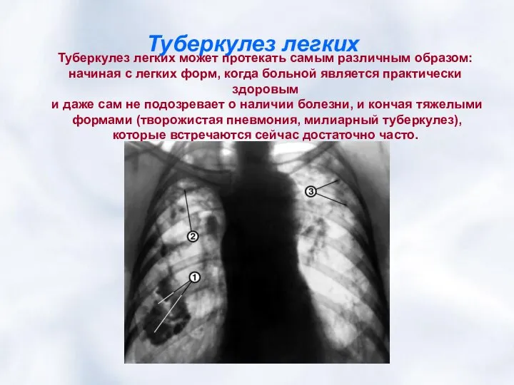 Туберкулез легких Туберкулез легких может протекать самым различным образом: начиная с