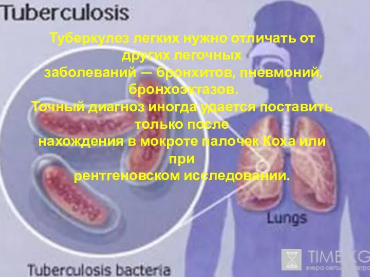 Туберкулез легких нужно отличать от других легочных заболеваний — бронхитов, пневмоний,