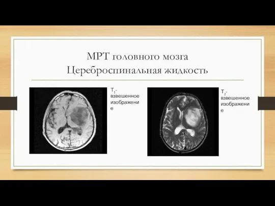 МРТ головного мозга Цереброспинальная жидкость Т1-взвешенное изображение Т2-взвешенное изображение