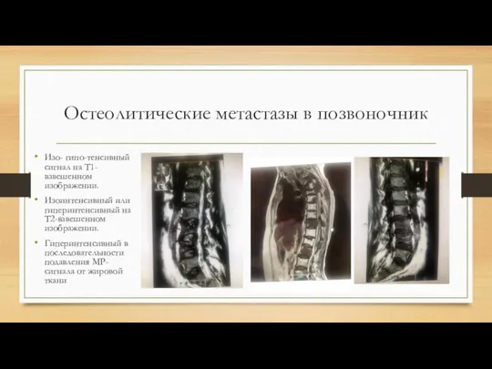 Остеолитические метастазы в позвоночник Изо- гипо-тенсивный сигнал на Т1-взвешенном изображении. Изоинтенсивный