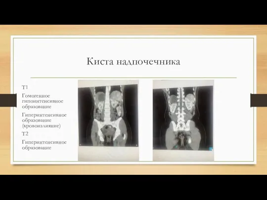 Киста надпочечника Т1 Гомогенное гипоинтенсивное образование Гиперинтенсивное образование (кровоизлияние) Т2 Гиперинтенсивное образование