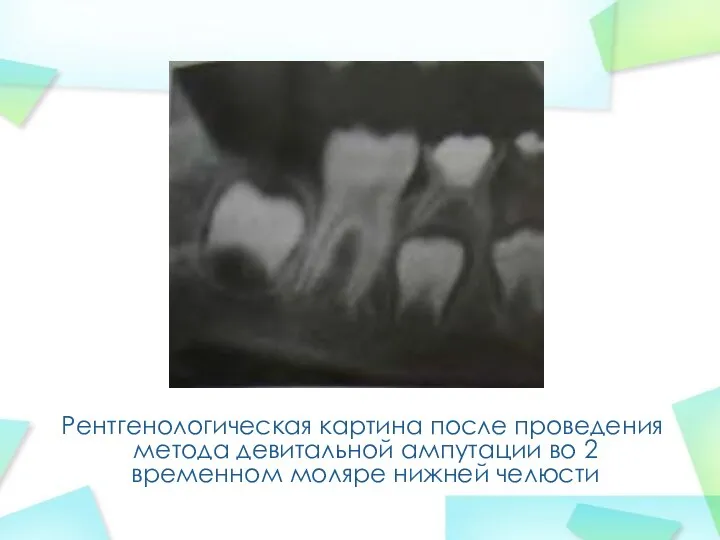 Рентгенологическая картина после проведения метода девитальной ампутации во 2 временном моляре нижней челюсти