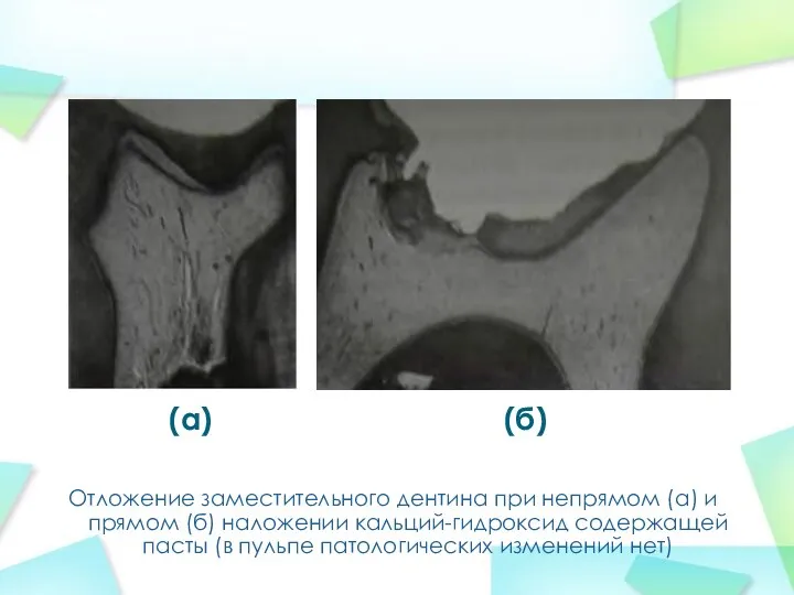 Отложение заместительного дентина при непрямом (а) и прямом (б) наложении кальций-гидроксид