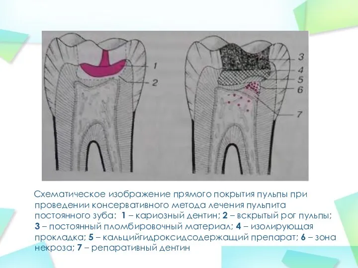 Схематическое изображение прямого покрытия пульпы при проведении консервативного метода лечения пульпита