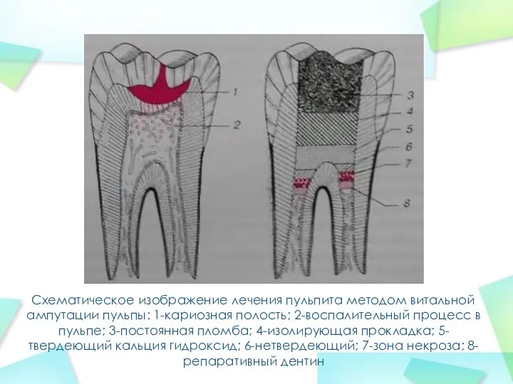 Схематическое изображение лечения пульпита методом витальной ампутации пульпы: 1-кариозная полость; 2-воспалительный