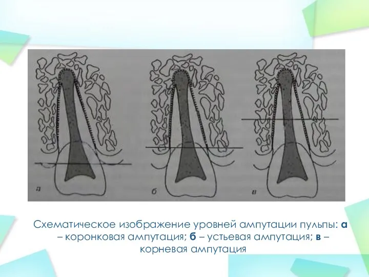 Схематическое изображение уровней ампутации пульпы: а – коронковая ампутация; б –