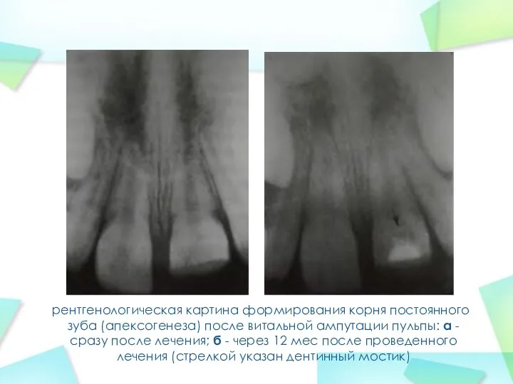 рентгенологическая картина формирования корня постоянного зуба (апексогенеза) после витальной ампутации пульпы: