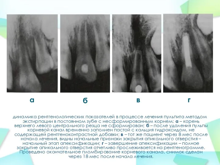 динамика рентгенологических показателей в процессе лечения пульпита методом экстирпации в постоянном