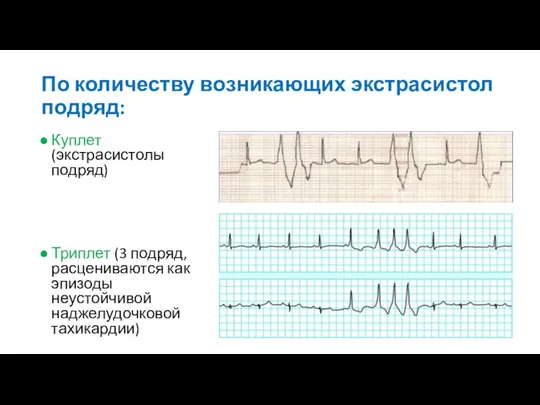 По количеству возникающих экстрасистол подряд: Куплет (экстрасистолы подряд) Триплет (3 подряд,