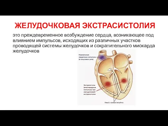 ЖЕЛУДОЧКОВАЯ ЭКСТРАСИСТОЛИЯ это преждевременное возбуждение сердца, возникающее под влиянием импульсов, исходящих